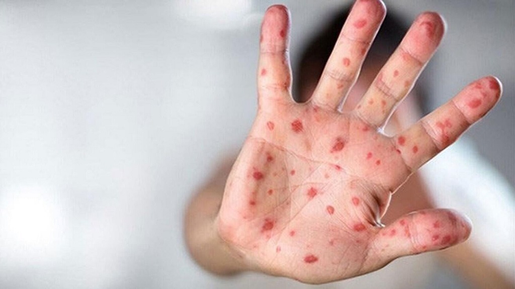 Sağlık Bakanlığı'ndan maymun çiçeği (MPOX) rehberi